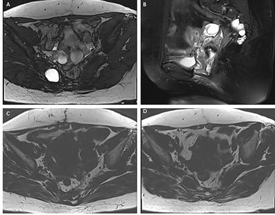 Adenocarcinoma arising in an ectopic enterogenous cyst: A rare case report and review of literature